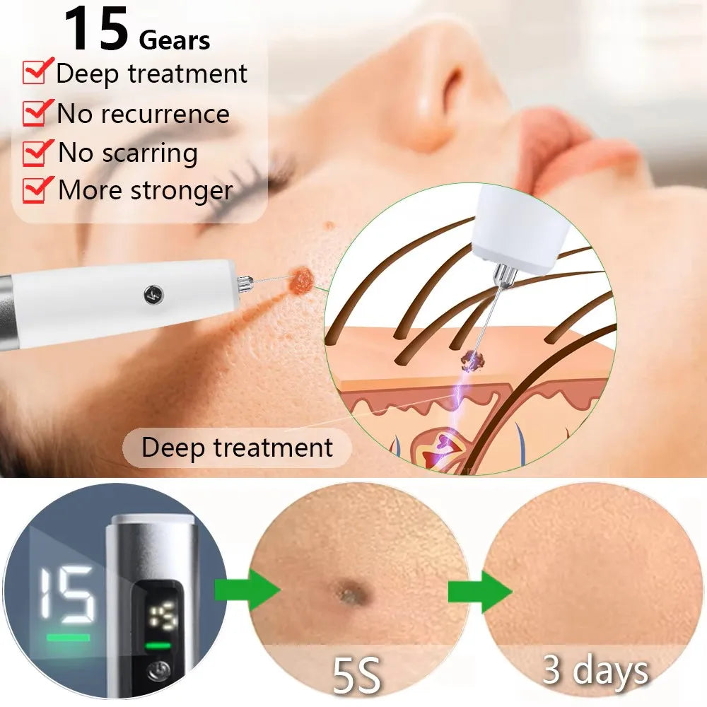 Electric Skin Tag Remover Pen